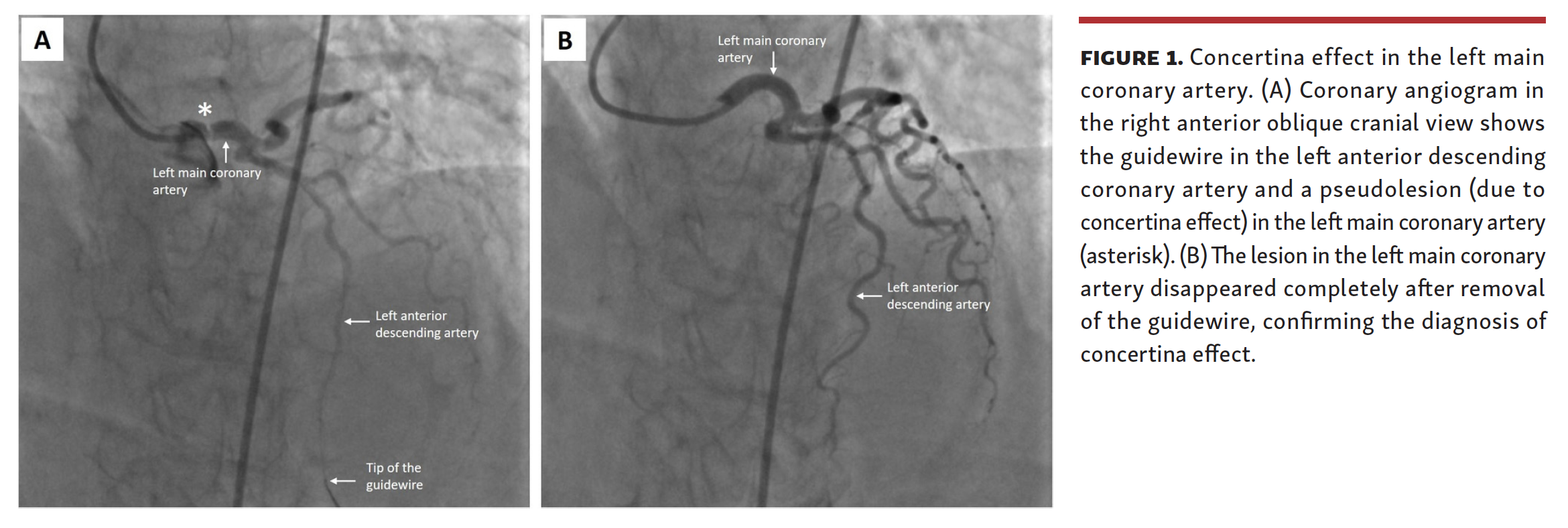 A Phantom Lesion in the Left Main Coronary Artery Concertina Effect
